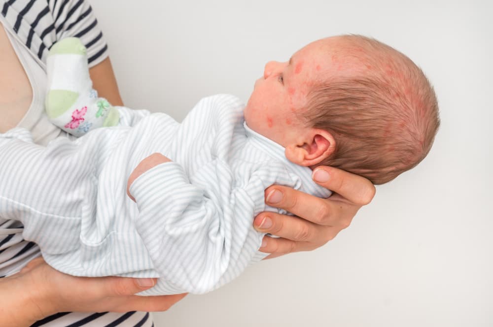 Newborn baby with a skin rash—possible allergic reaction after birth as the body begins to detoxify.