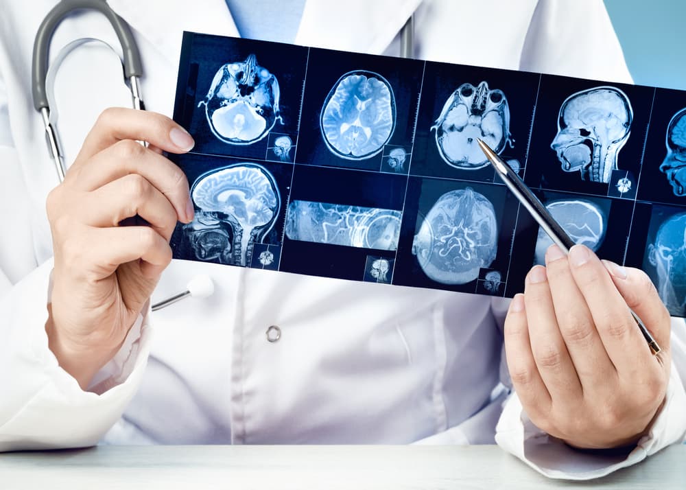 A female doctor points to an X-ray or MRI scan showing the head and neck, highlighting the spinal cord, blood vessels, and brain tissue for neurological evaluation.